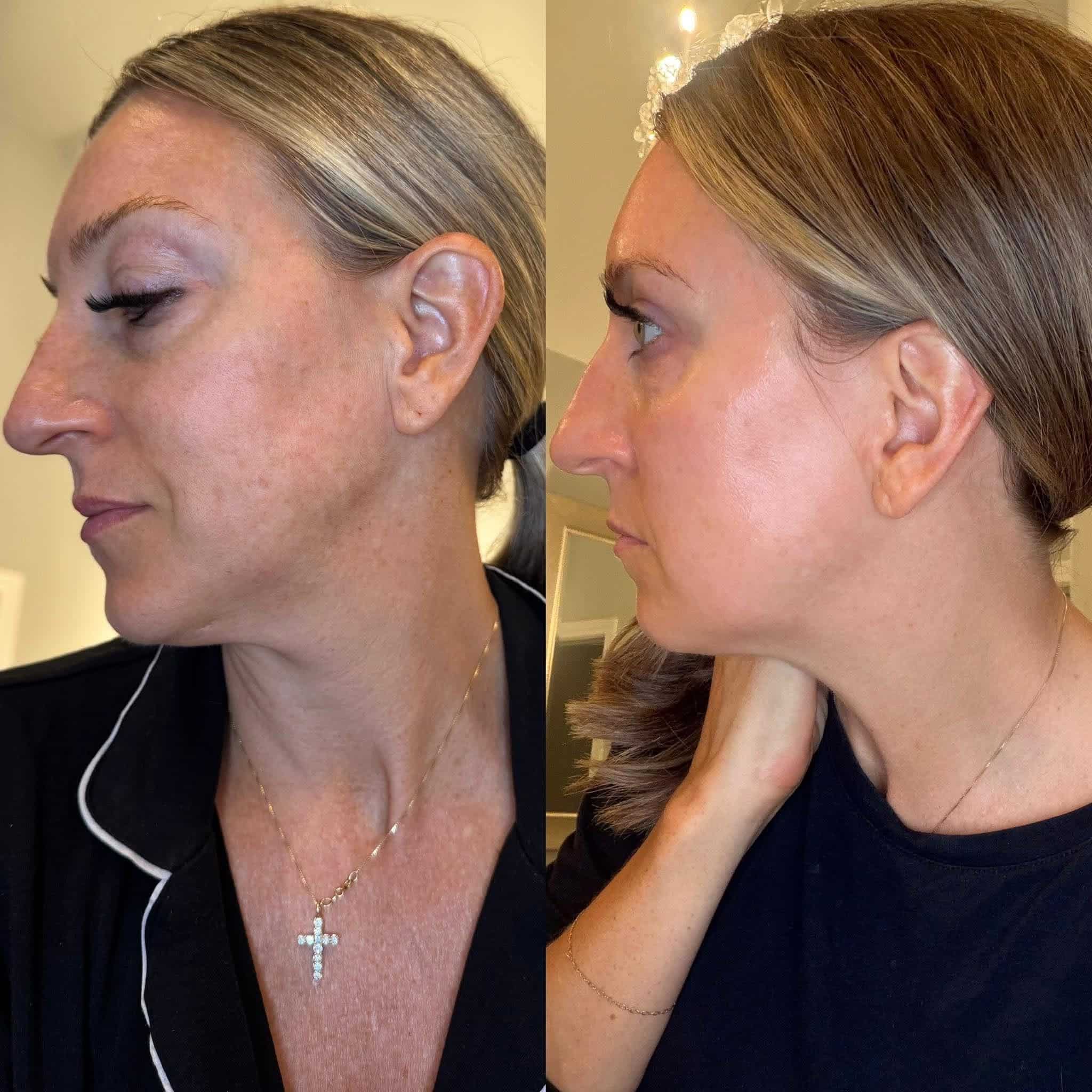 Melanie Mitro Exosome Serum Results
